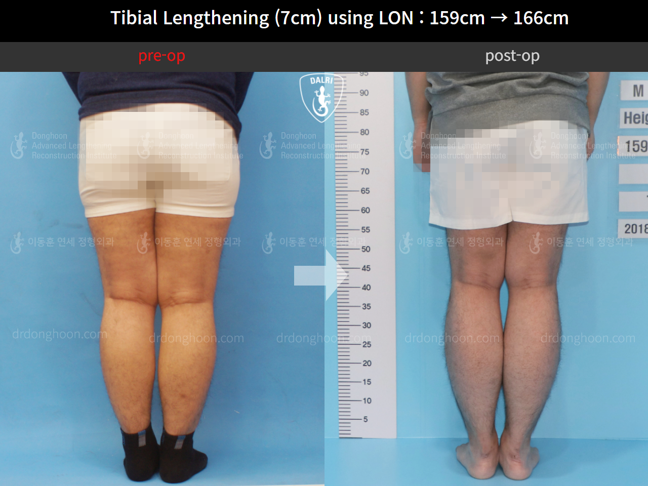 Before and after cll lon, case 9869704, image 4, Dr. Donghoon institute (DALRI)