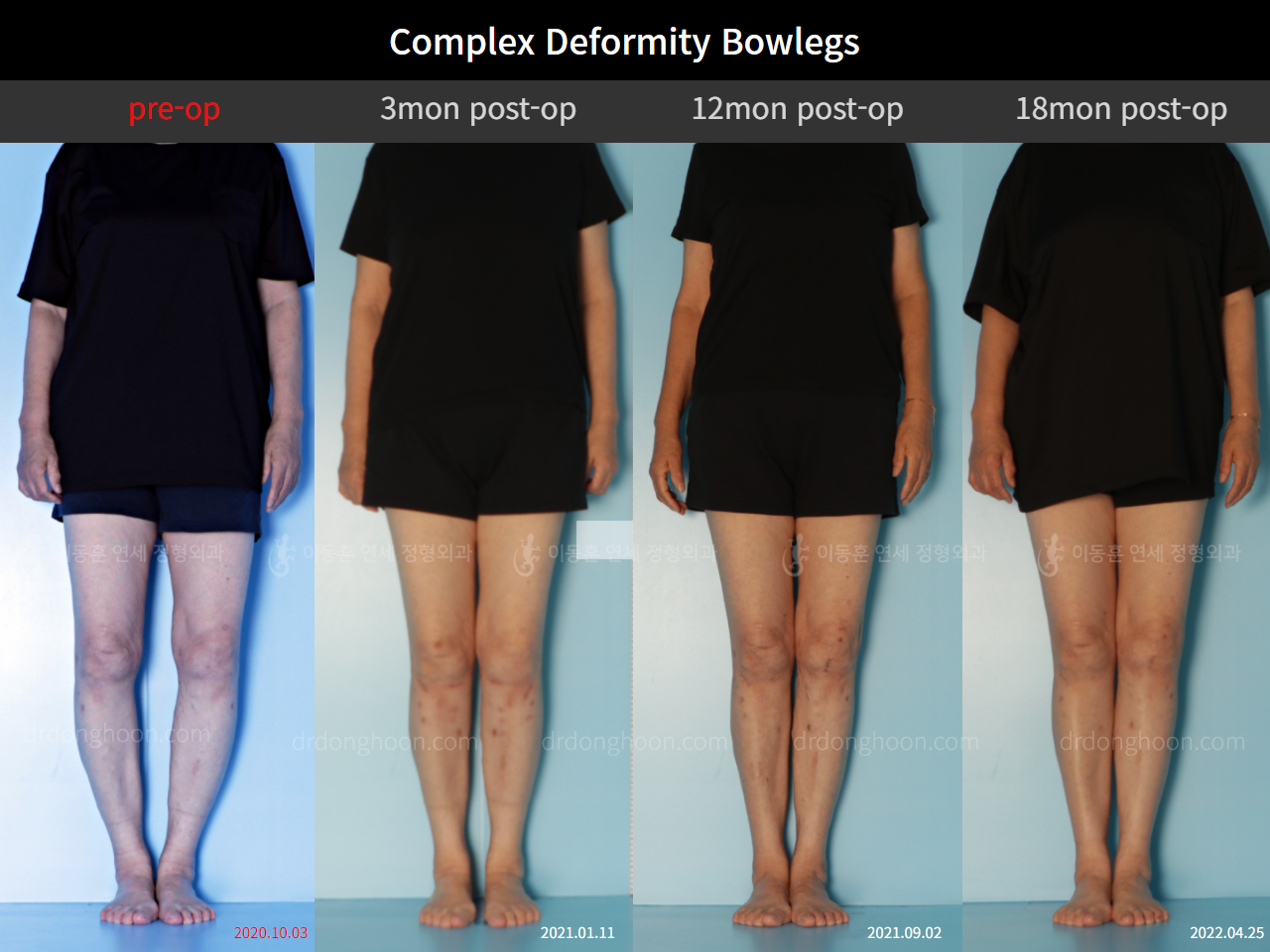Before and after osteotomy for knee osteoarthritis, case 11337460, image 1, Dr. Donghoon institute (DALRI)
