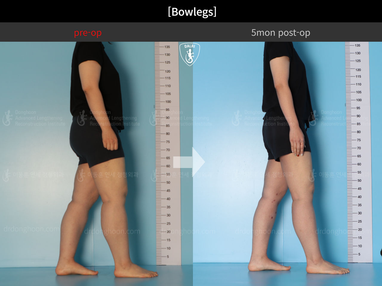 Before and after adult bowlegs, case 13212059, image 7, Dr. Donghoon institute (DALRI)