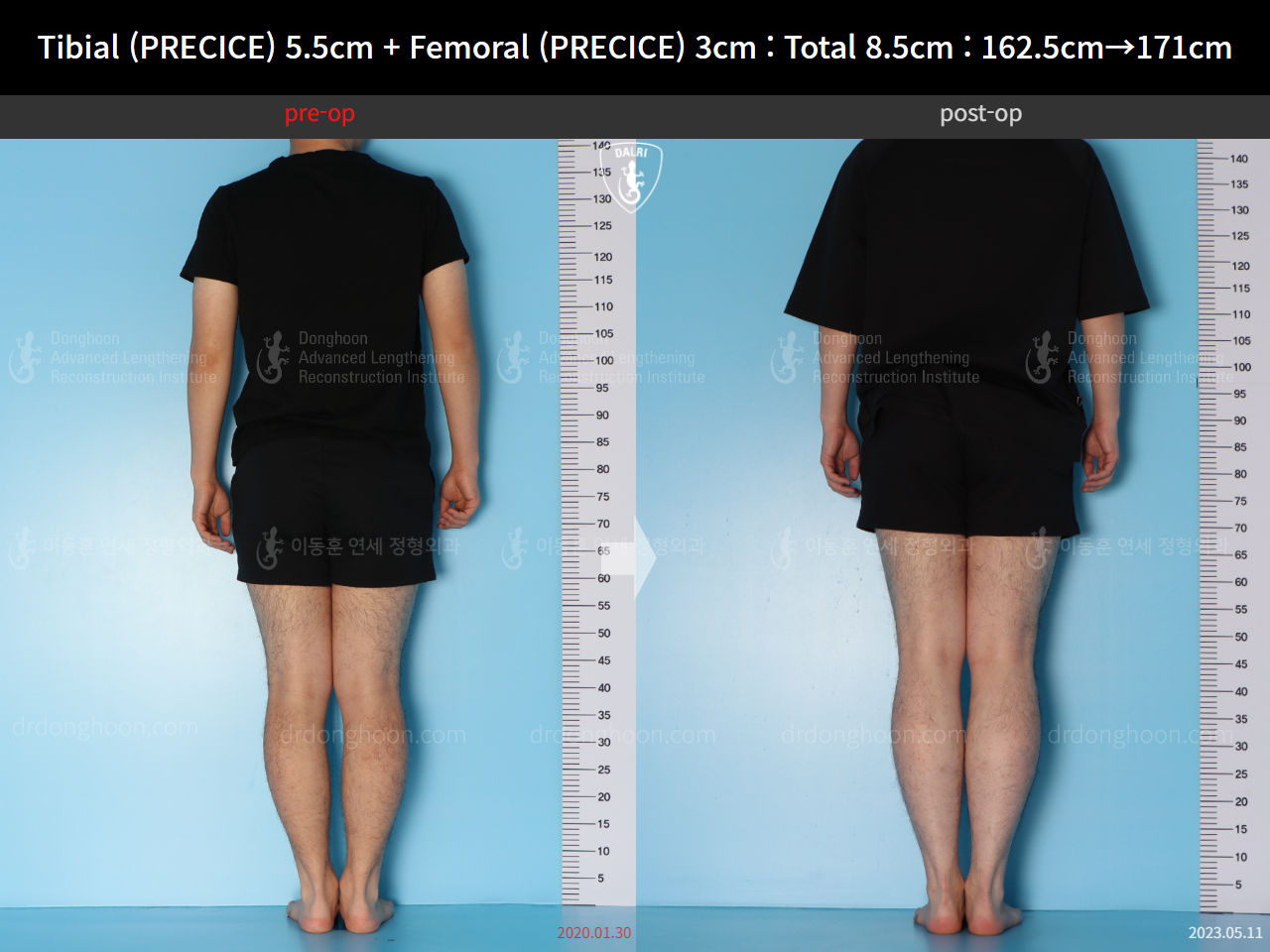 Before and after cll precice, case 15140008, image 3, Dr. Donghoon institute (DALRI)