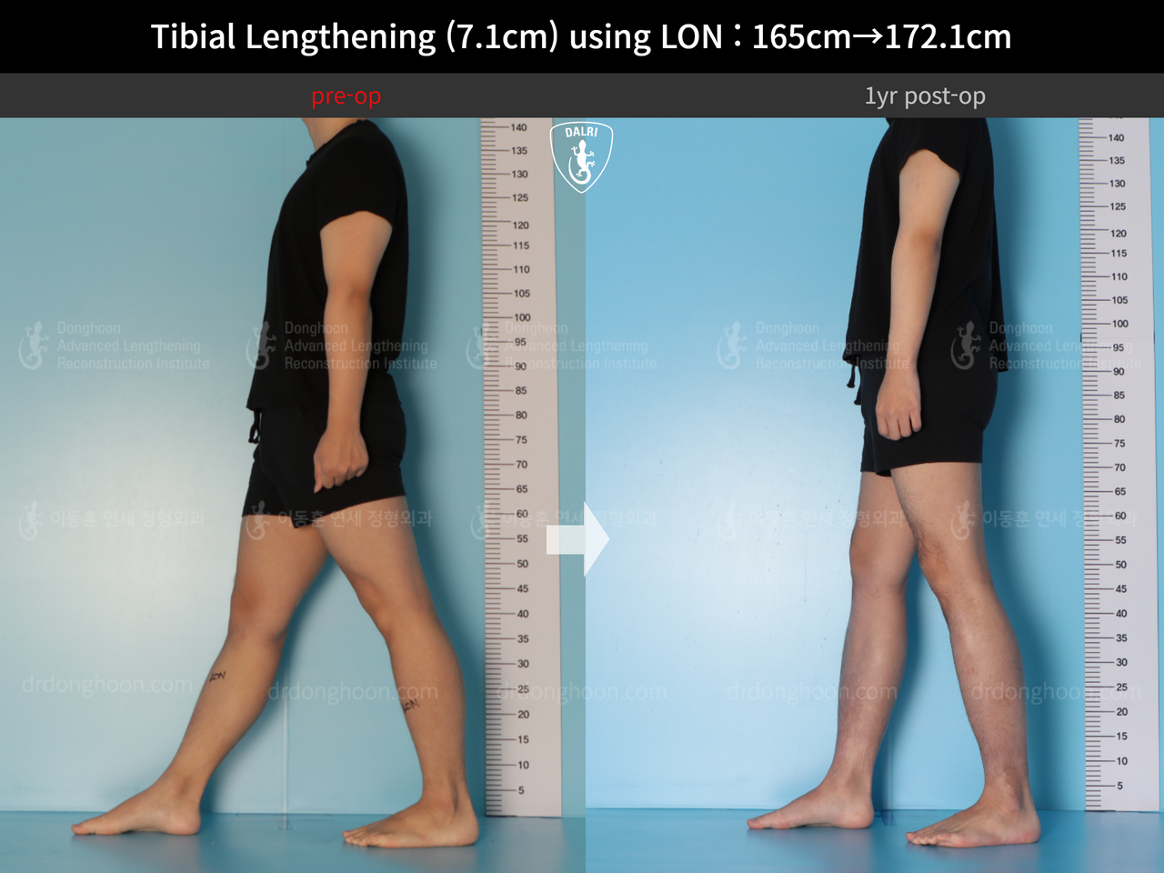 Before and after cll lon, case 14318674, image 6, Dr. Donghoon institute (DALRI)
