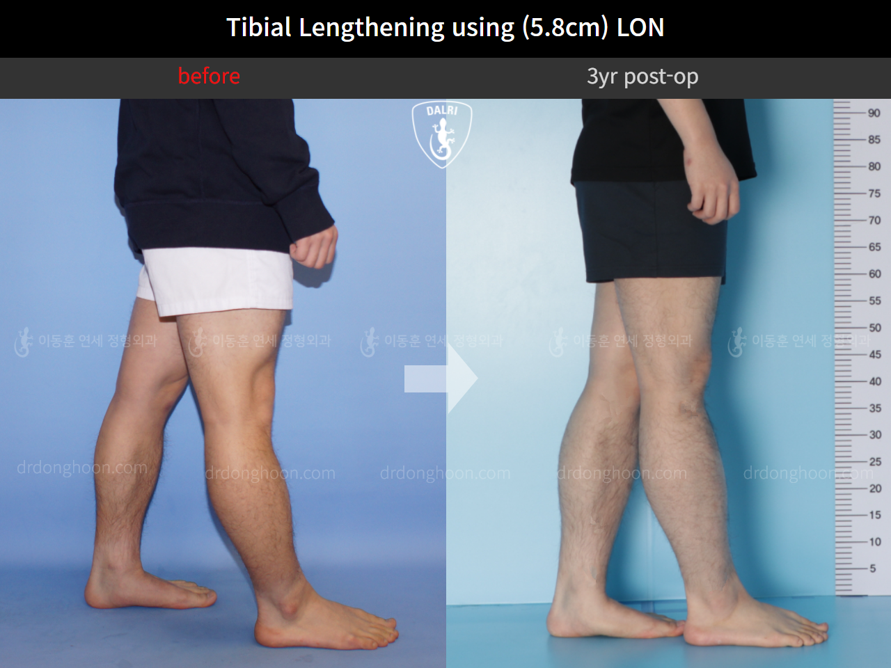 Before and after cll lon, case 10336887, image 7, Dr. Donghoon institute (DALRI)