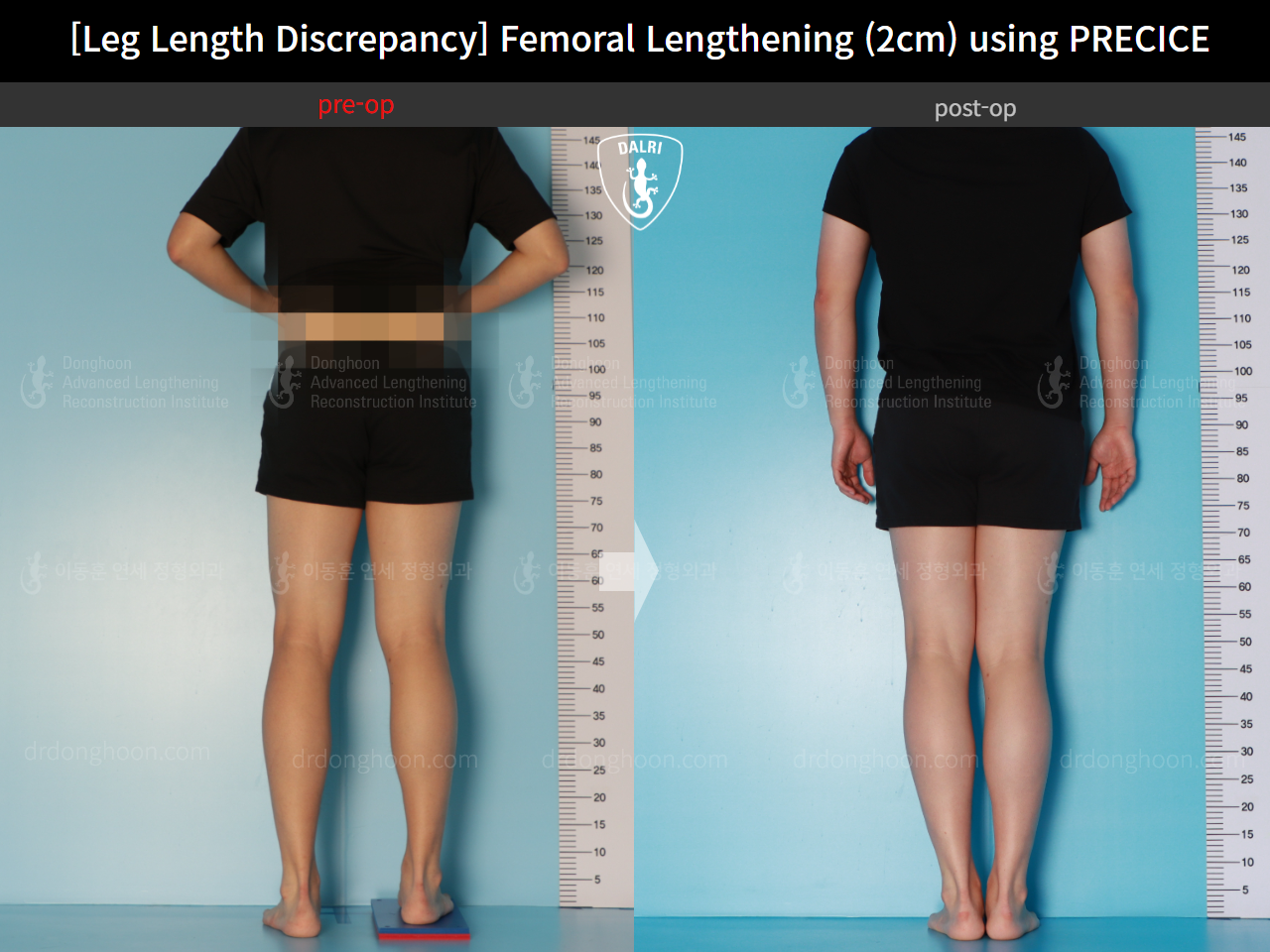 Before and after adult lld, case 16061128, image 2, Dr. Donghoon institute (DALRI)