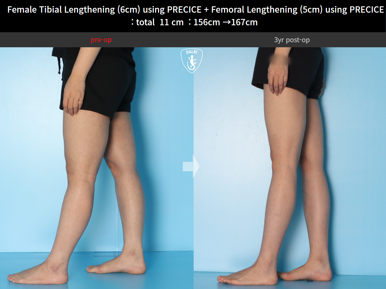 Before and after cll precice, case 24986271, image 7, Dr. Donghoon institute (DALRI)