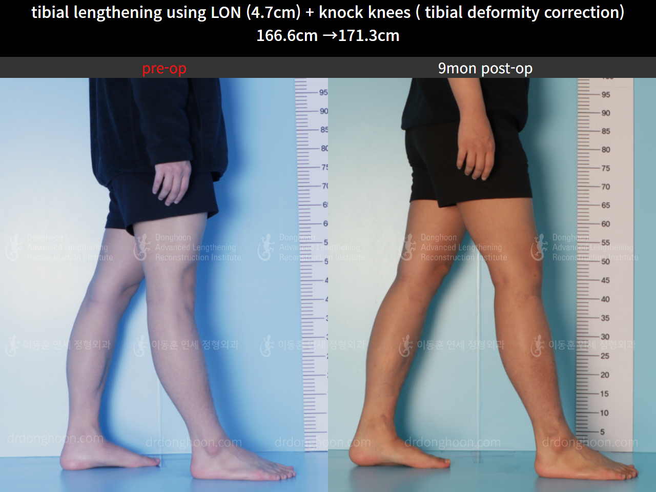 Before and after cll + deformity correction, case 8583829, image 8, Dr. Donghoon institute (DALRI)