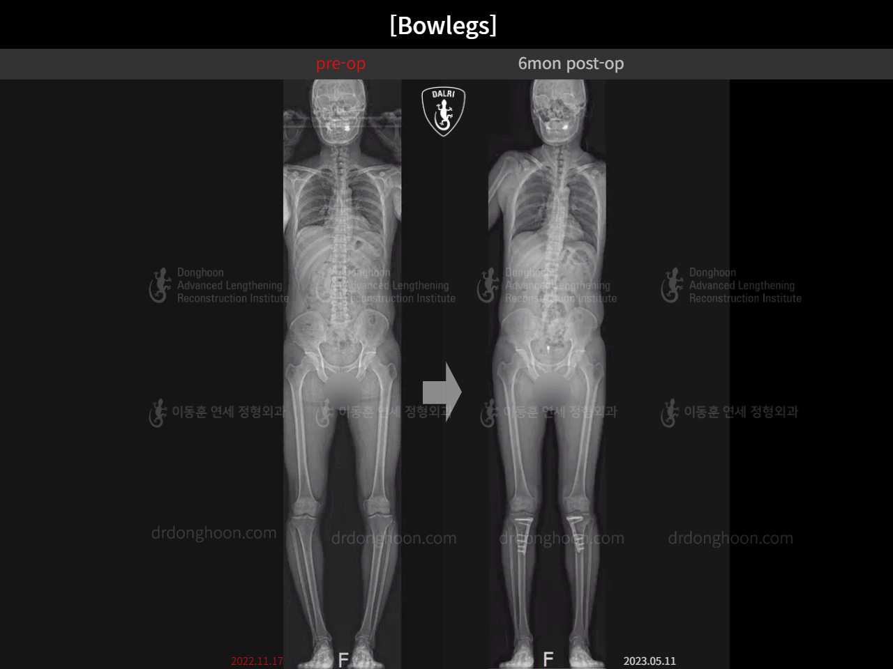 Before and after adult bowlegs, case 15161898, image 1, Dr. Donghoon institute (DALRI)
