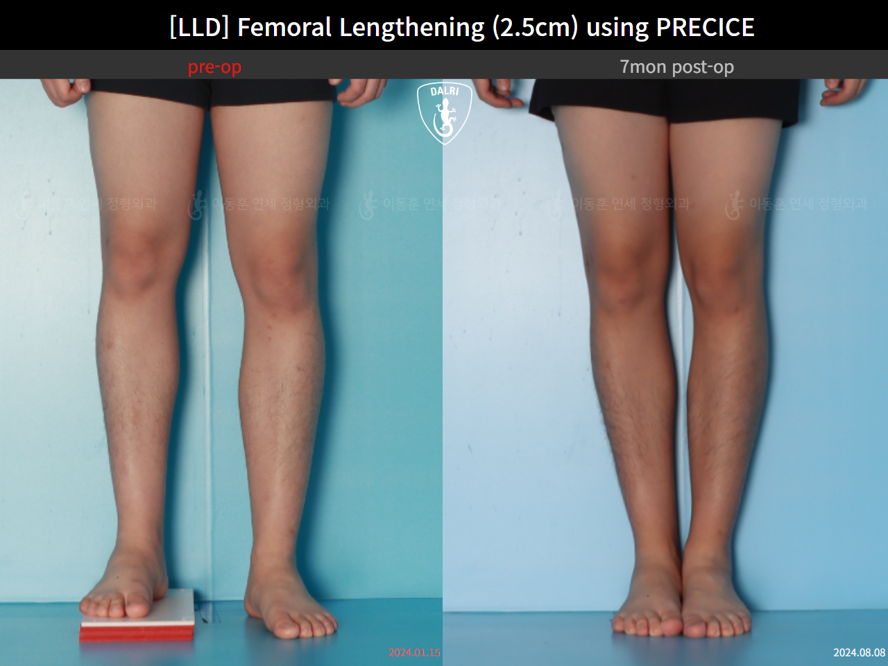 Before and after adult lld, case 127180202, image 5, Dr. Donghoon institute (DALRI)