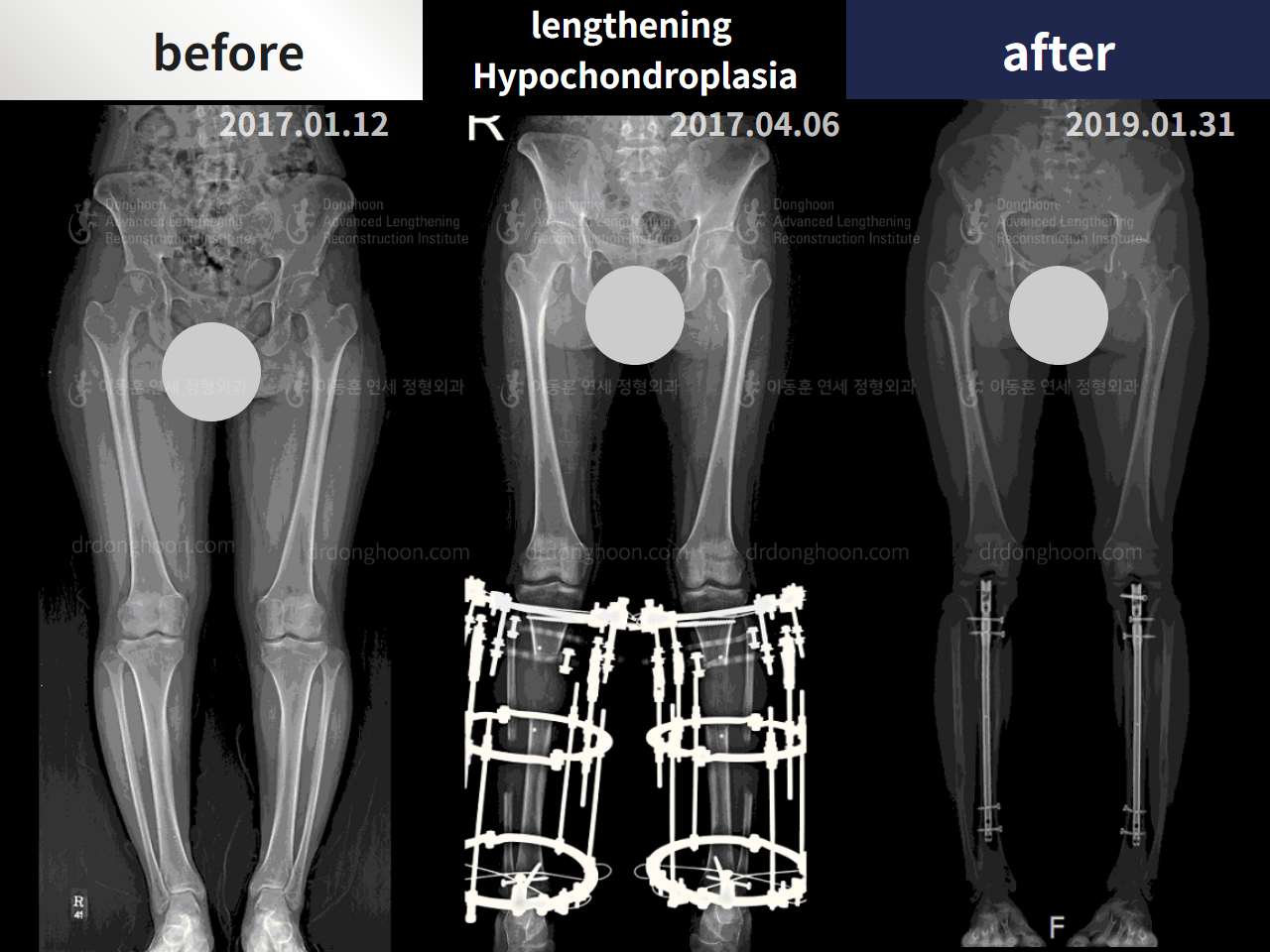 Before and after congenital condition, case 4304657, image 3, Dr. Donghoon institute (DALRI)