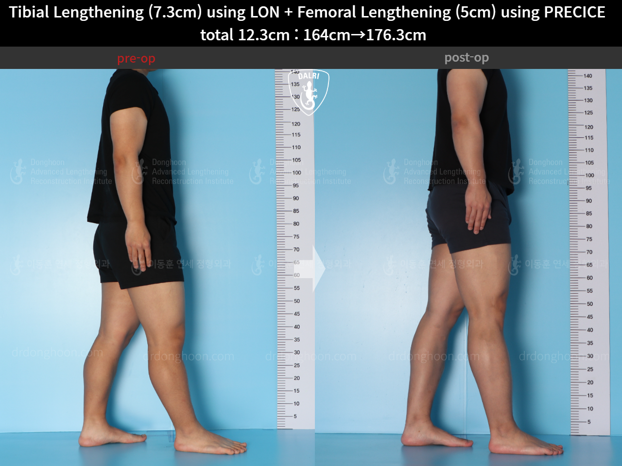 Before and after cll lon, case 15592729, image 3, Dr. Donghoon institute (DALRI)