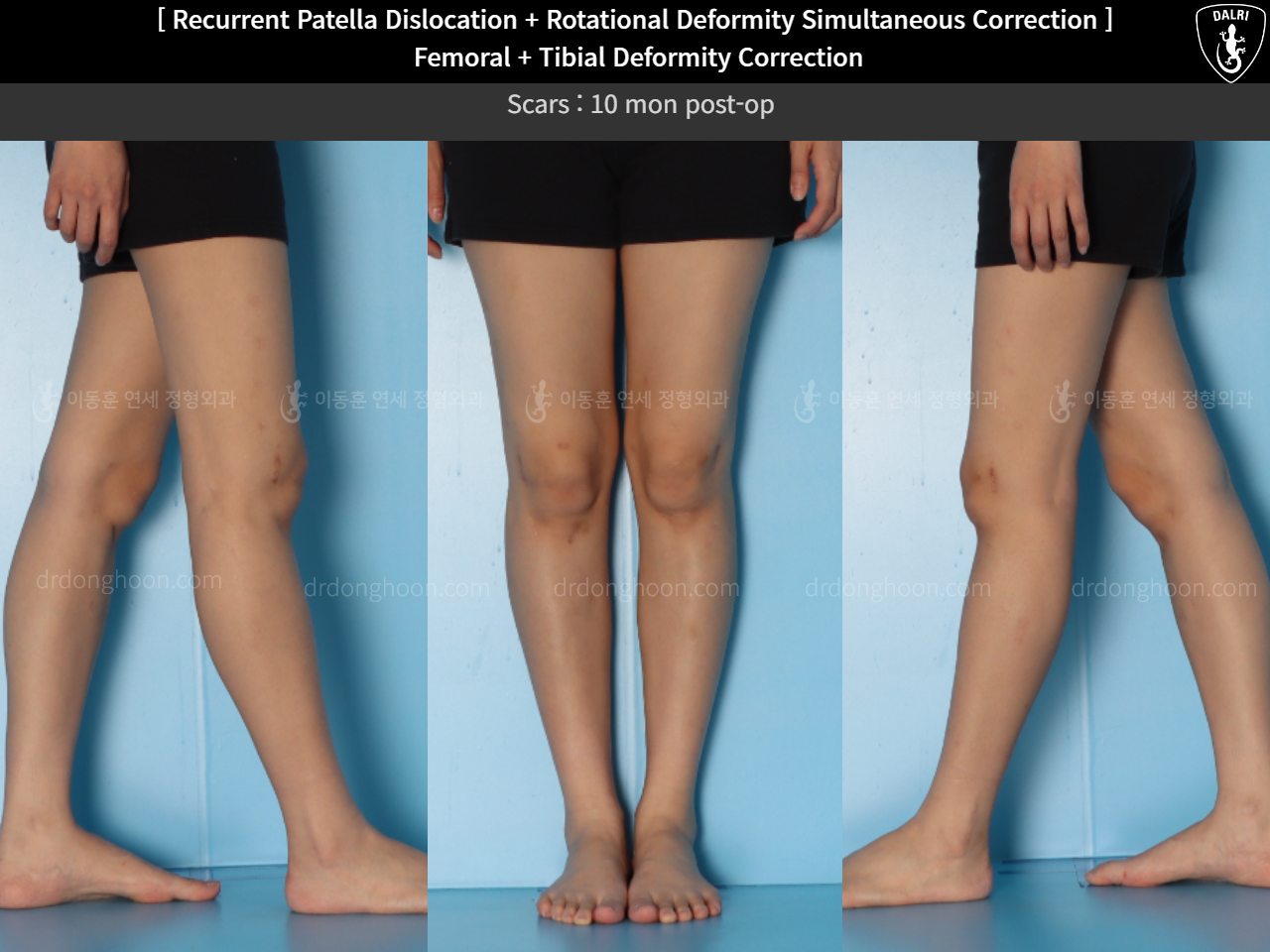 Before and after adult bowlegs, case 15131364, image 4, Dr. Donghoon institute (DALRI)