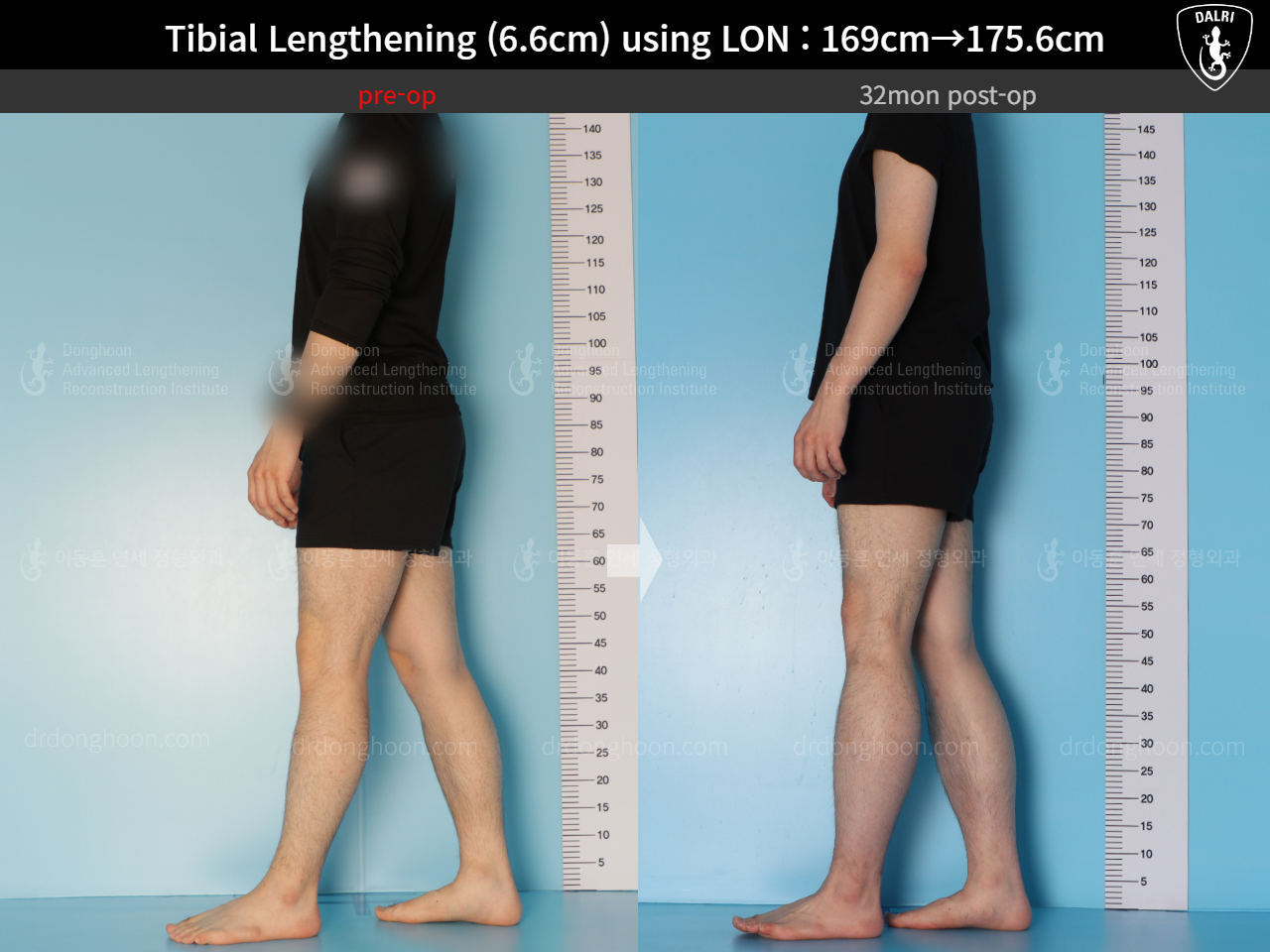 Before and after cll lon, case 15166302, image 8, Dr. Donghoon institute (DALRI)