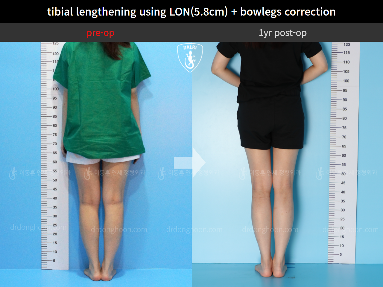 Before and after cll + deformity correction, case 11210566, image 2, Dr. Donghoon institute (DALRI)