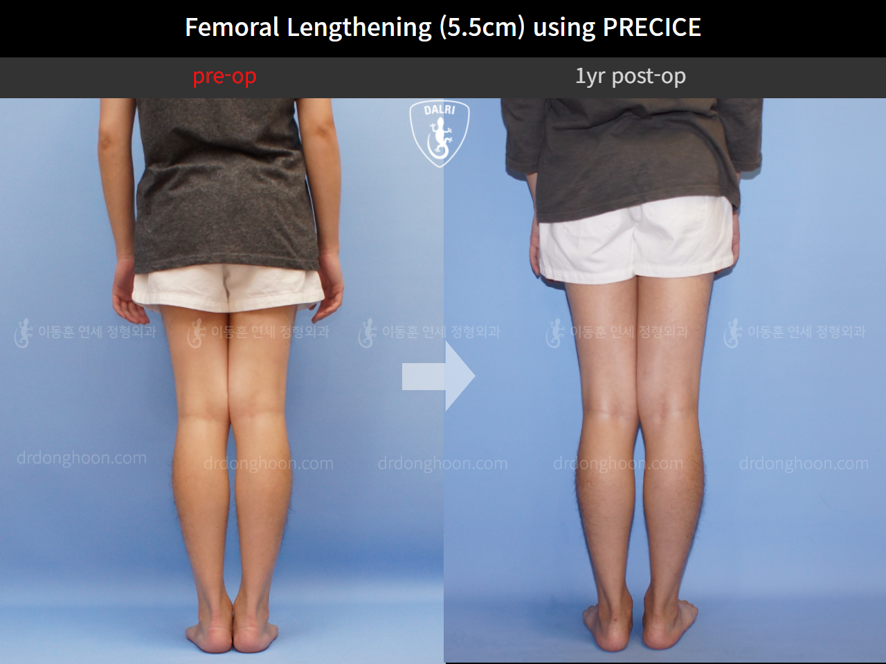 Before and after cll precice, case 4323383, image 6, Dr. Donghoon institute (DALRI)