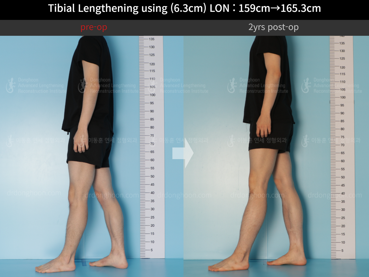 Before and after cll lon, case 12096536, image 6, Dr. Donghoon institute (DALRI)