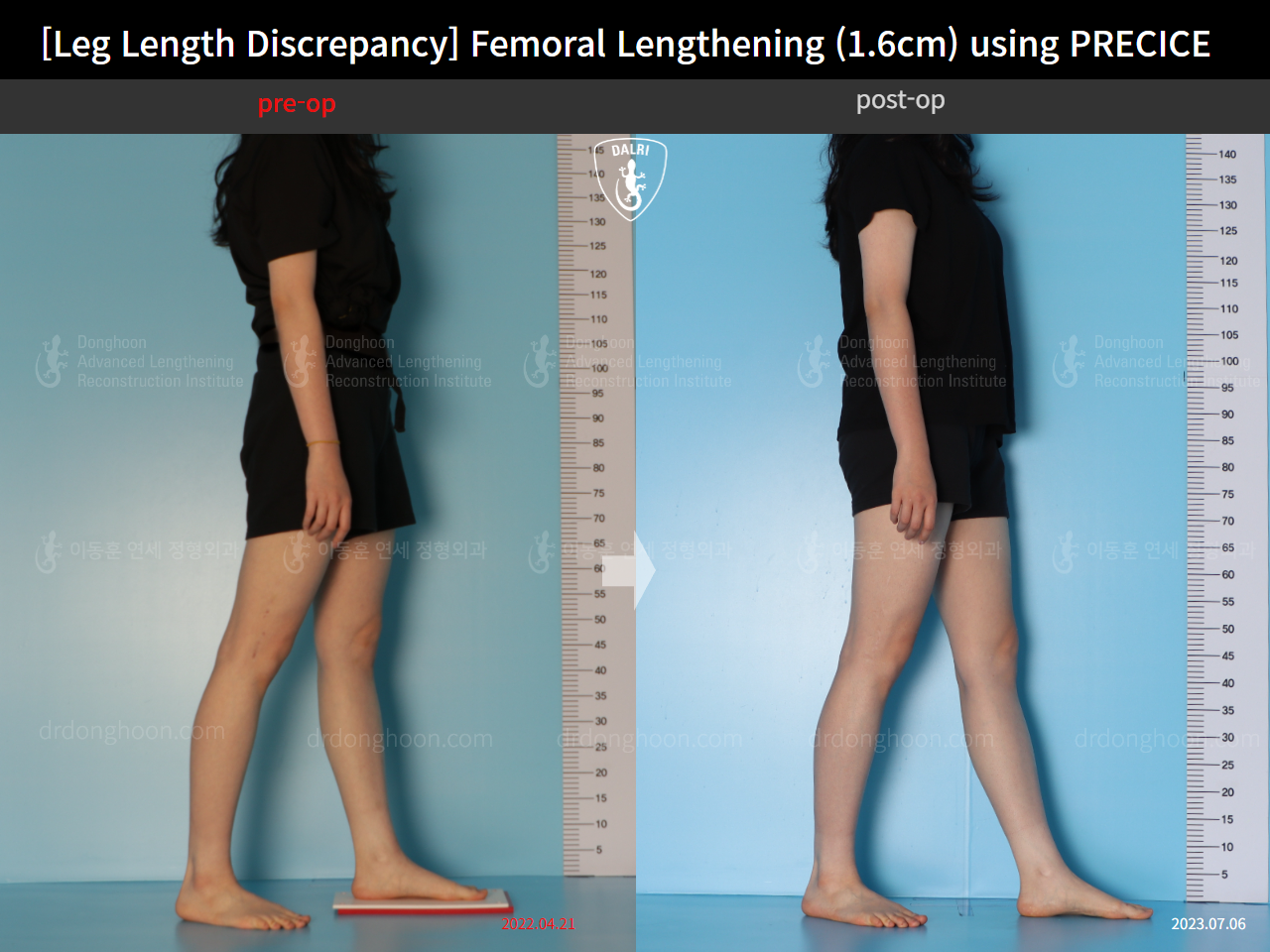 Before and after adult lld, case 15705968, image 6, Dr. Donghoon institute (DALRI)