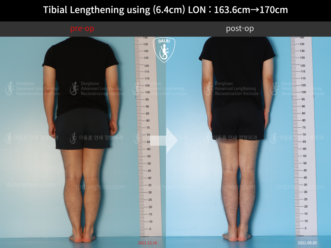 Before and after cll lon, case 12779092, image 2, Dr. Donghoon institute (DALRI)