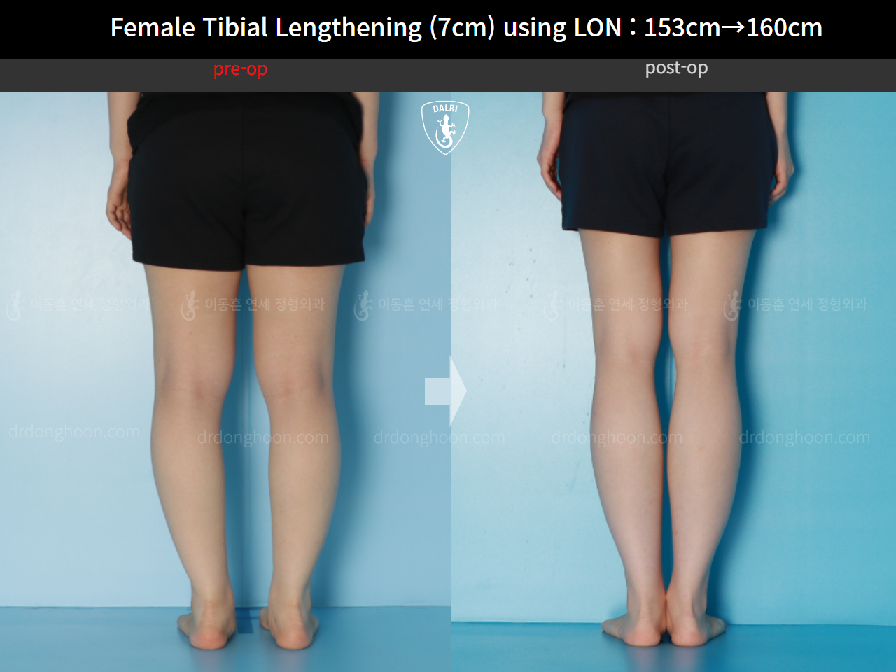 Before and after cll lon, case 16044134, image 6, Dr. Donghoon institute (DALRI)