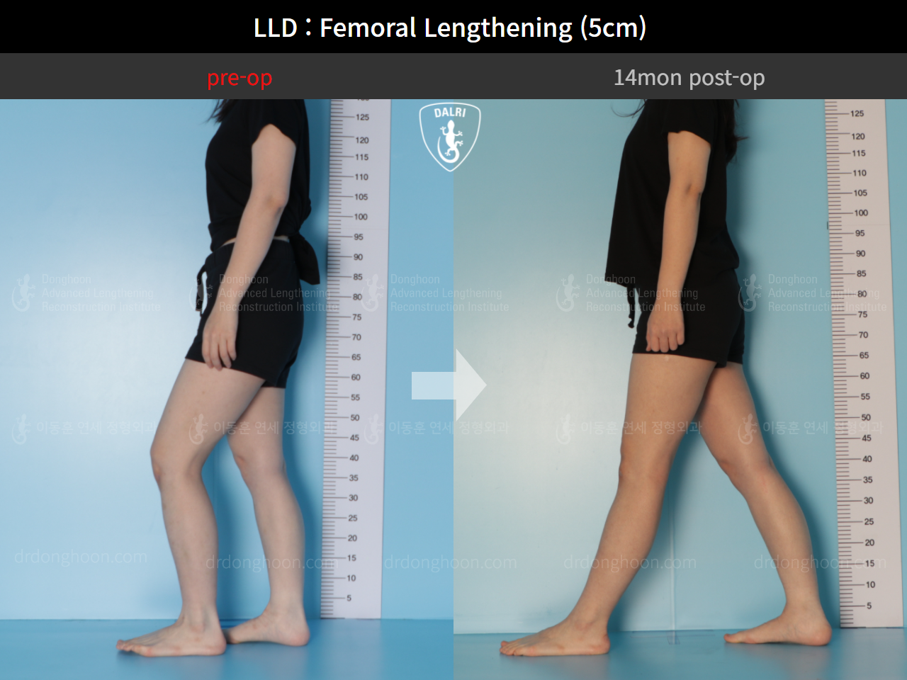 Before and after adult lld, case 9366304, image 3, Dr. Donghoon institute (DALRI)