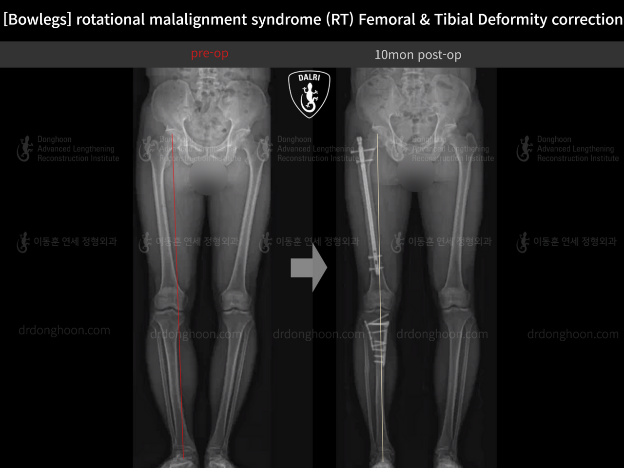 Before and after adult bowlegs, case 14220550, image 11, Dr. Donghoon institute (DALRI)
