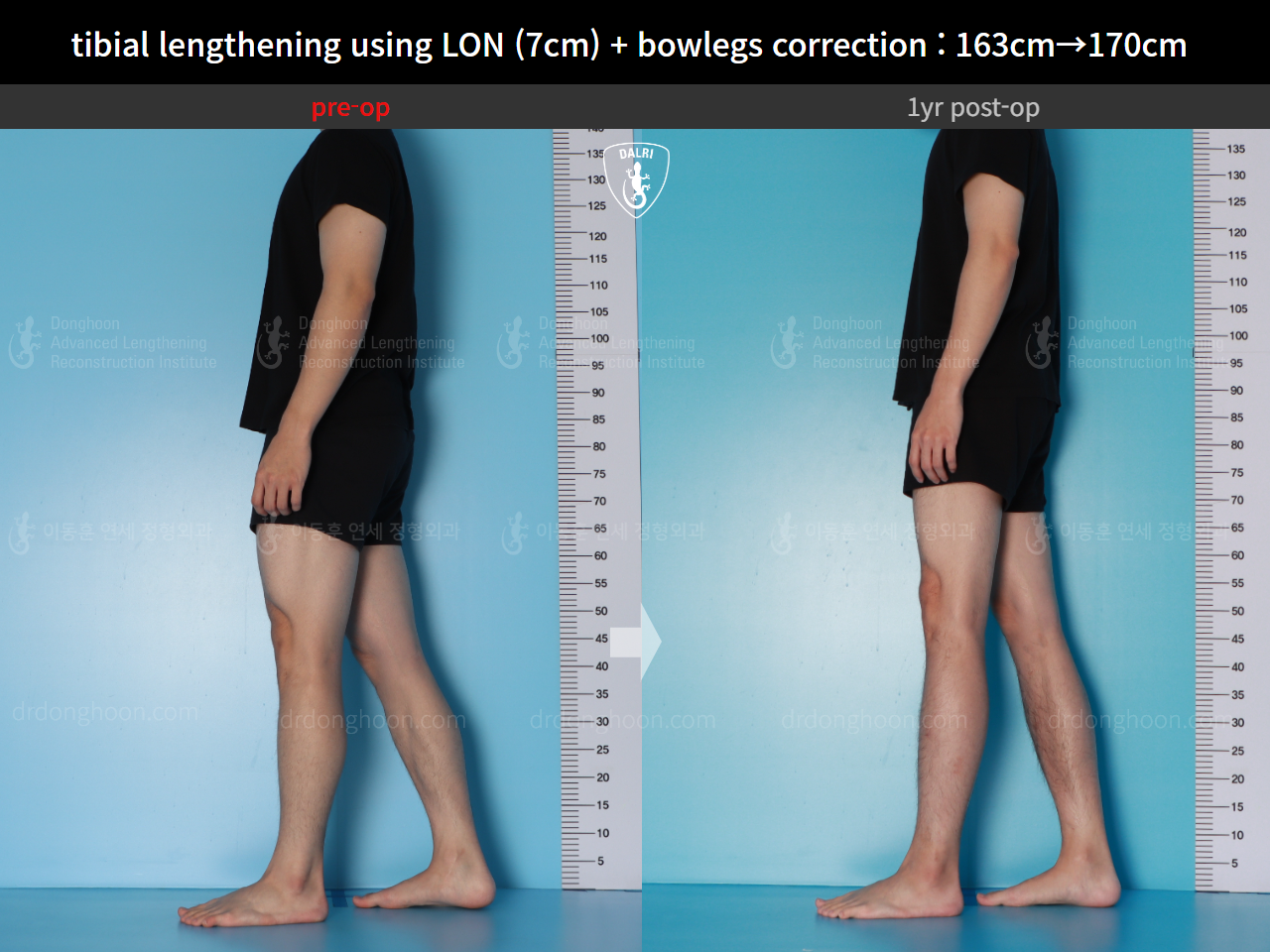 Before and after cll lon, case 16131902, image 5, Dr. Donghoon institute (DALRI)