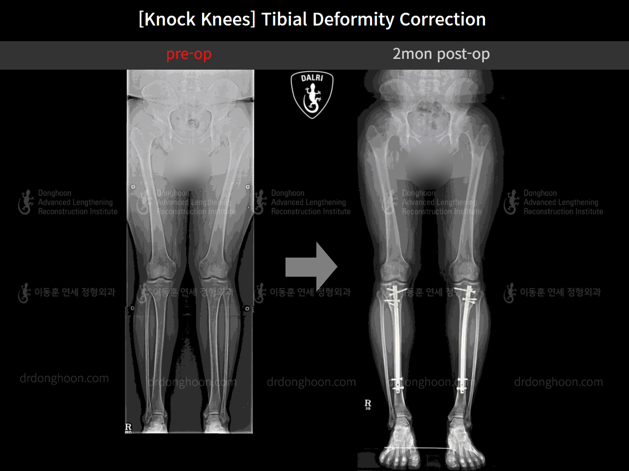 Before and after adult knock knees, case 4310814, image 5, Dr. Donghoon institute (DALRI)
