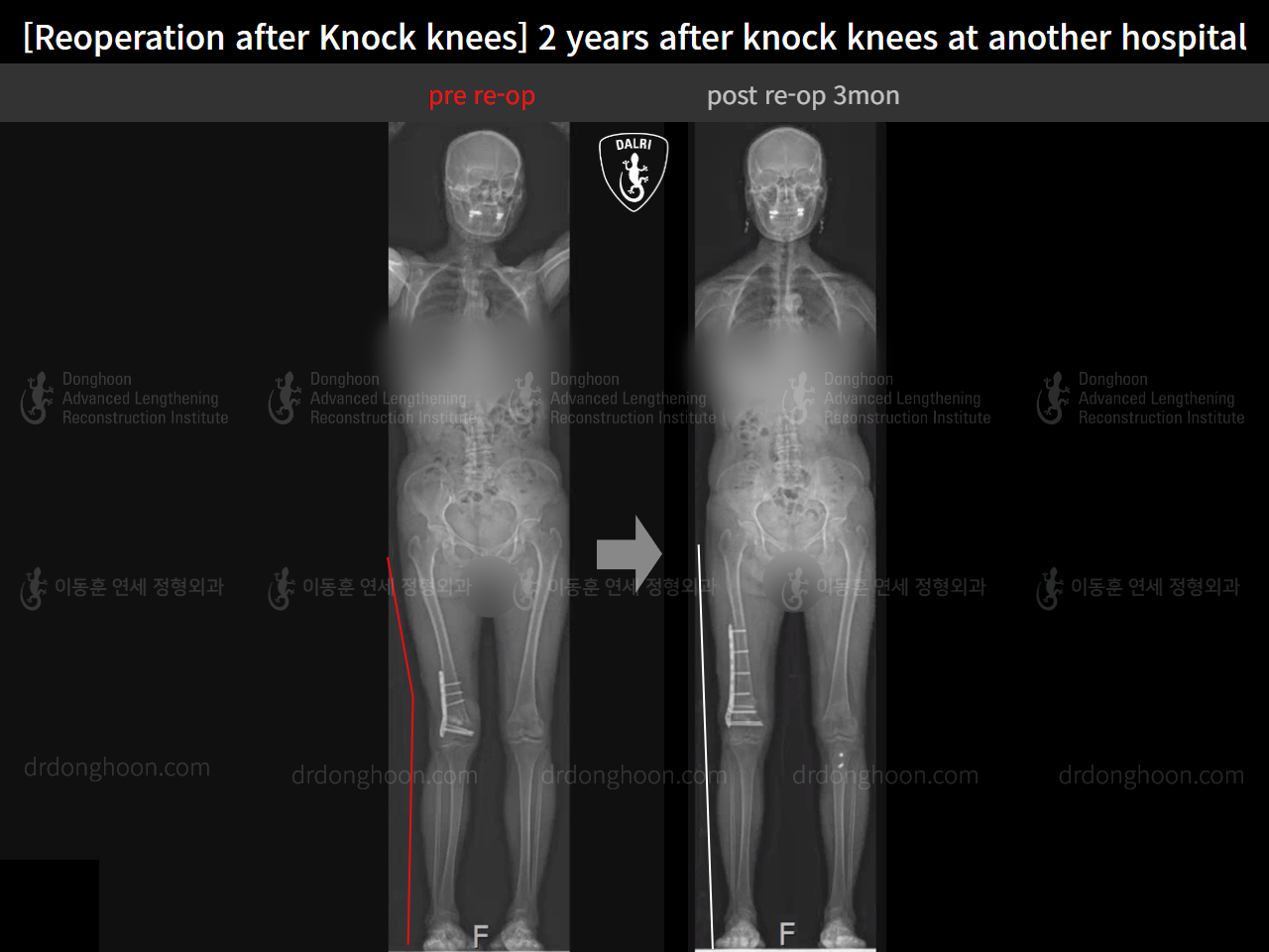 Before and after reoperation after deformity correction, case 15622876, image 12, Dr. Donghoon institute (DALRI)