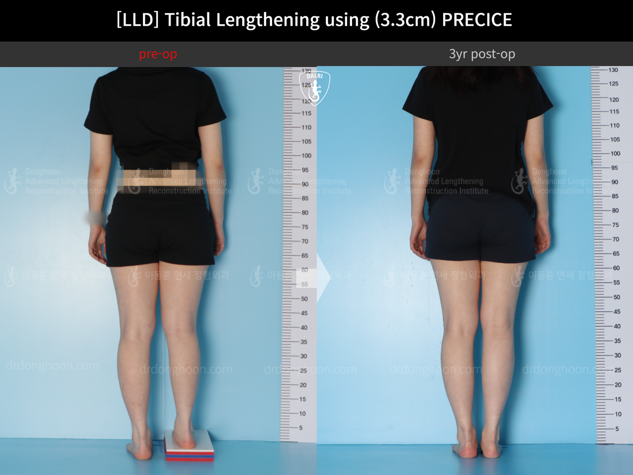 Before and after adult lld, case 14064905, image 4, Dr. Donghoon institute (DALRI)