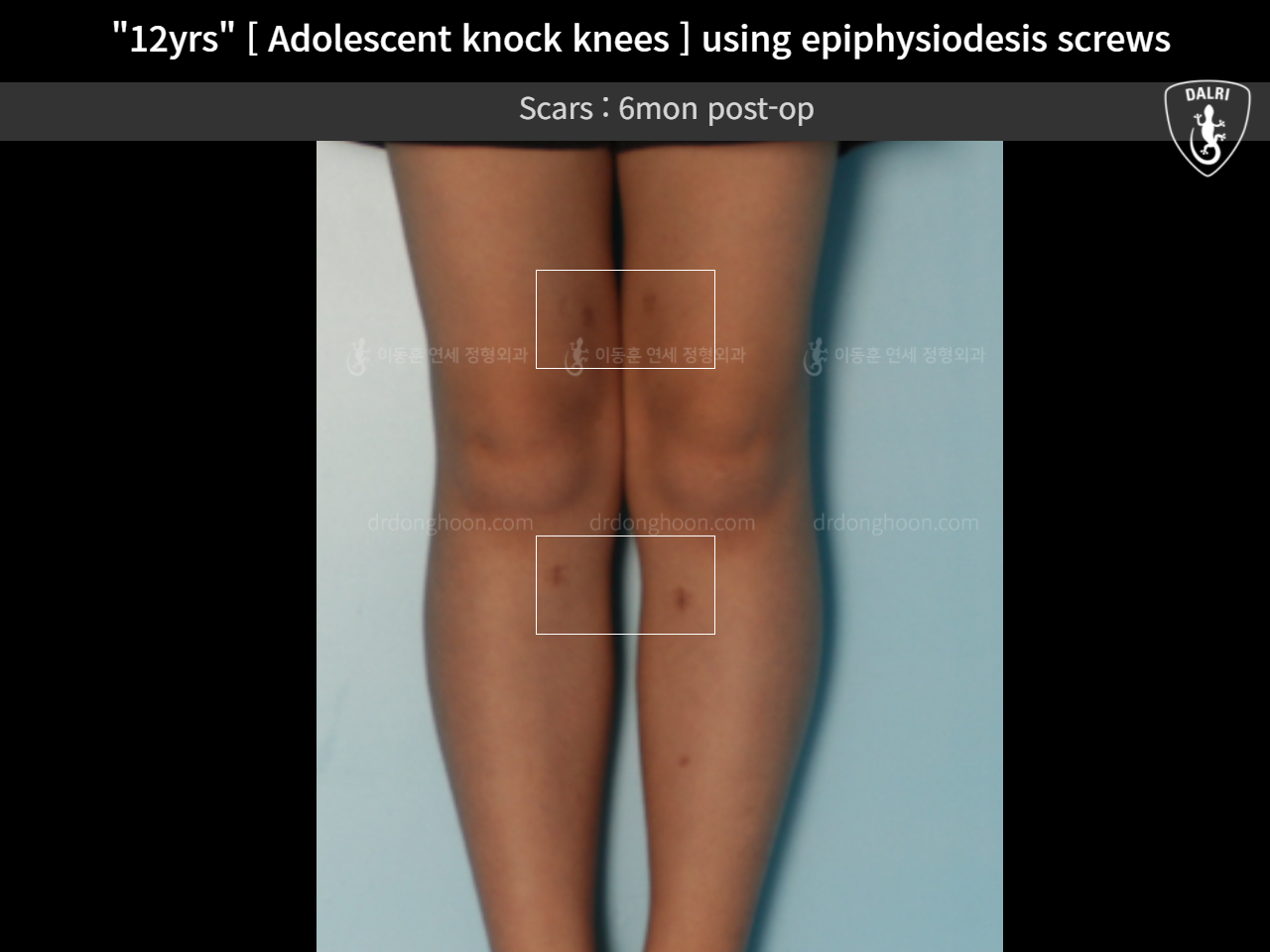 Before and after paediatric & adolescent knock knees, case 11772990, image 5, Dr. Donghoon institute (DALRI)