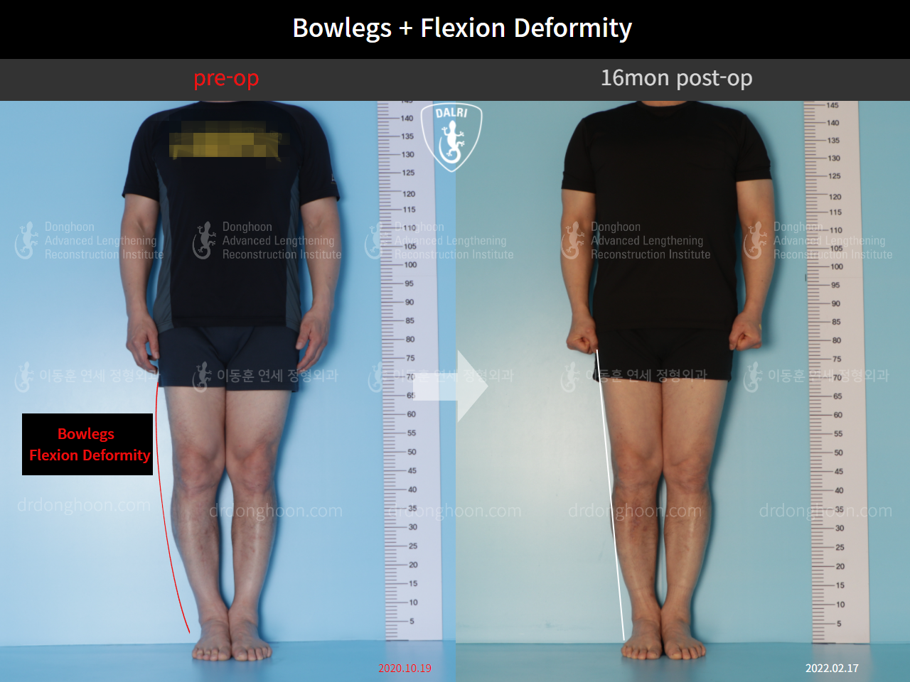 Before and after adult bowlegs, case 10451182, image 1, Dr. Donghoon institute (DALRI)