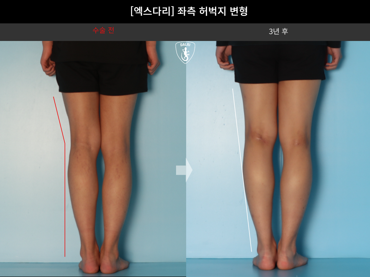 Before and after adult knock knees, case 18261918, image 6, Dr. Donghoon institute (DALRI)