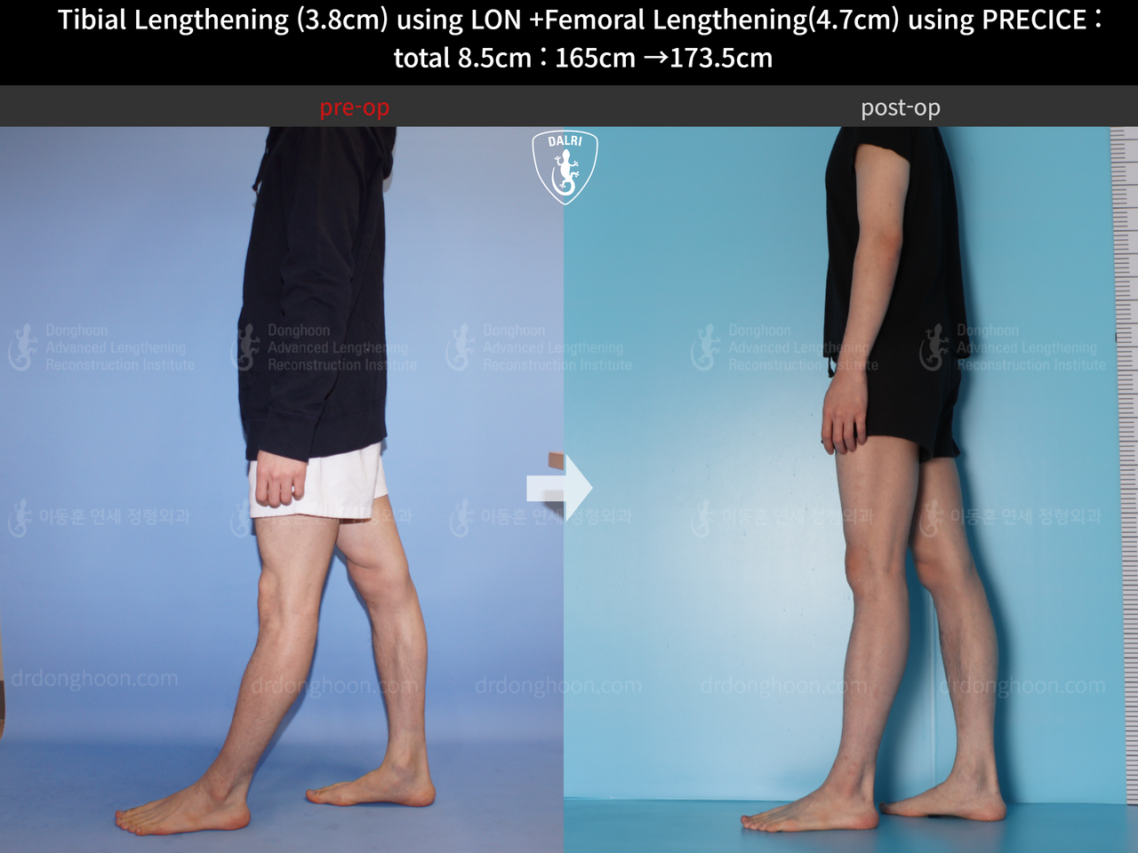 Before and after cll precice, case 4576980, image 8, Dr. Donghoon institute (DALRI)