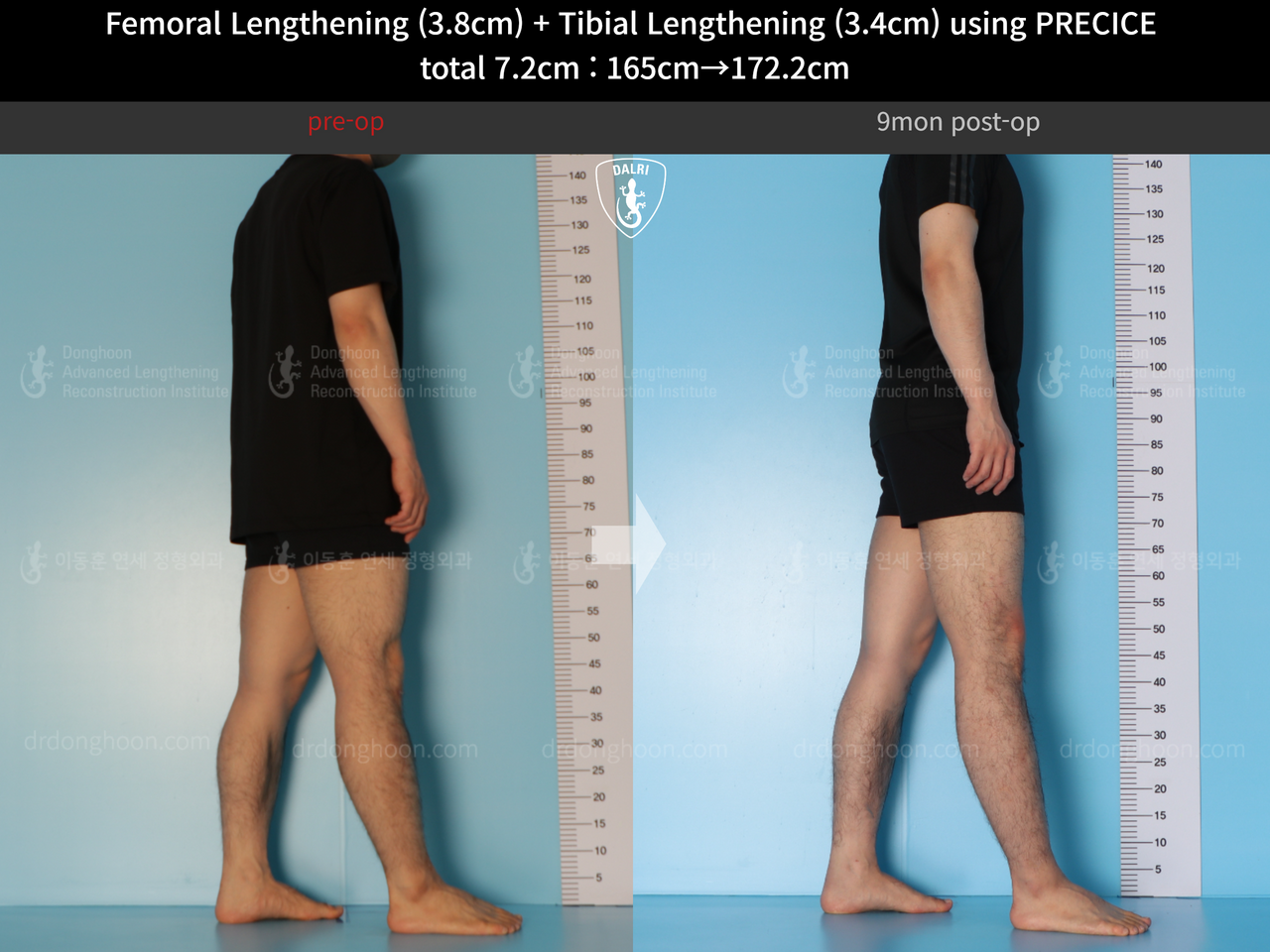 Before and after cll precice, case 14220657, image 3, Dr. Donghoon institute (DALRI)