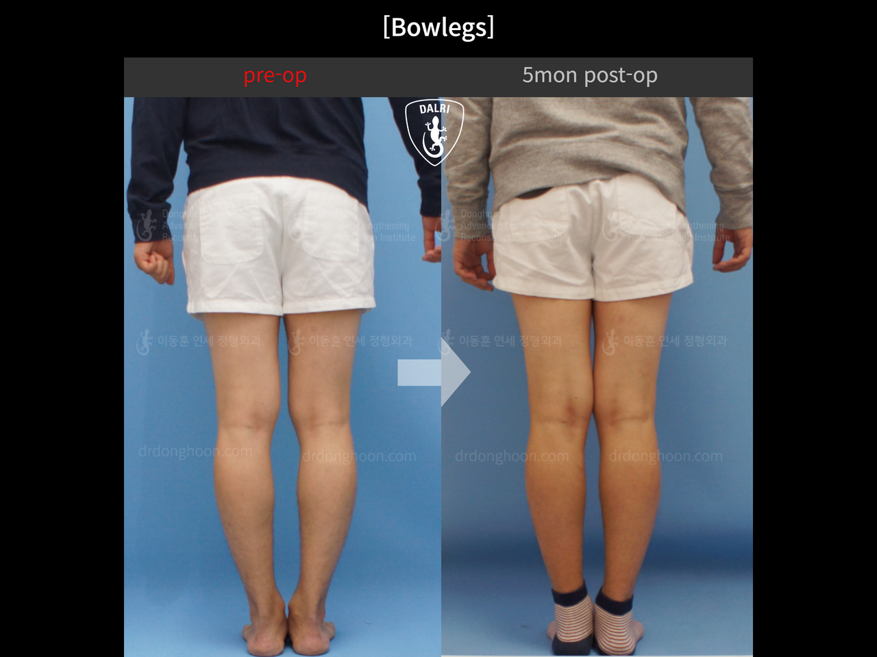 Before and after adult bowlegs, case 12818532, image 3, Dr. Donghoon institute (DALRI)