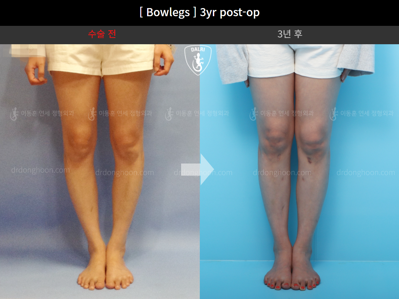Before and after adult bowlegs, case 4311006, image 2, Dr. Donghoon institute (DALRI)