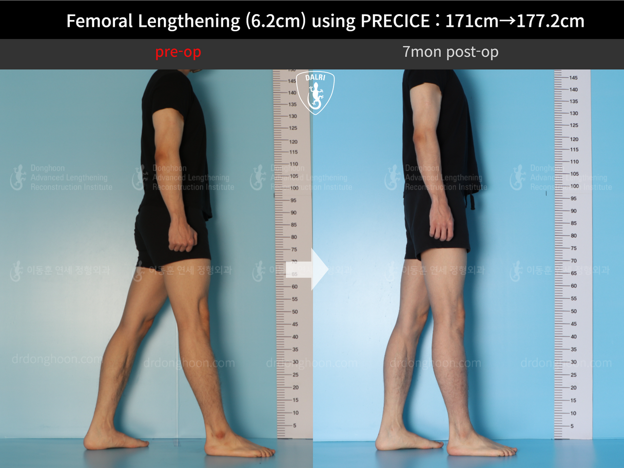 Before and after cll precice, case 13325833, image 5, Dr. Donghoon institute (DALRI)