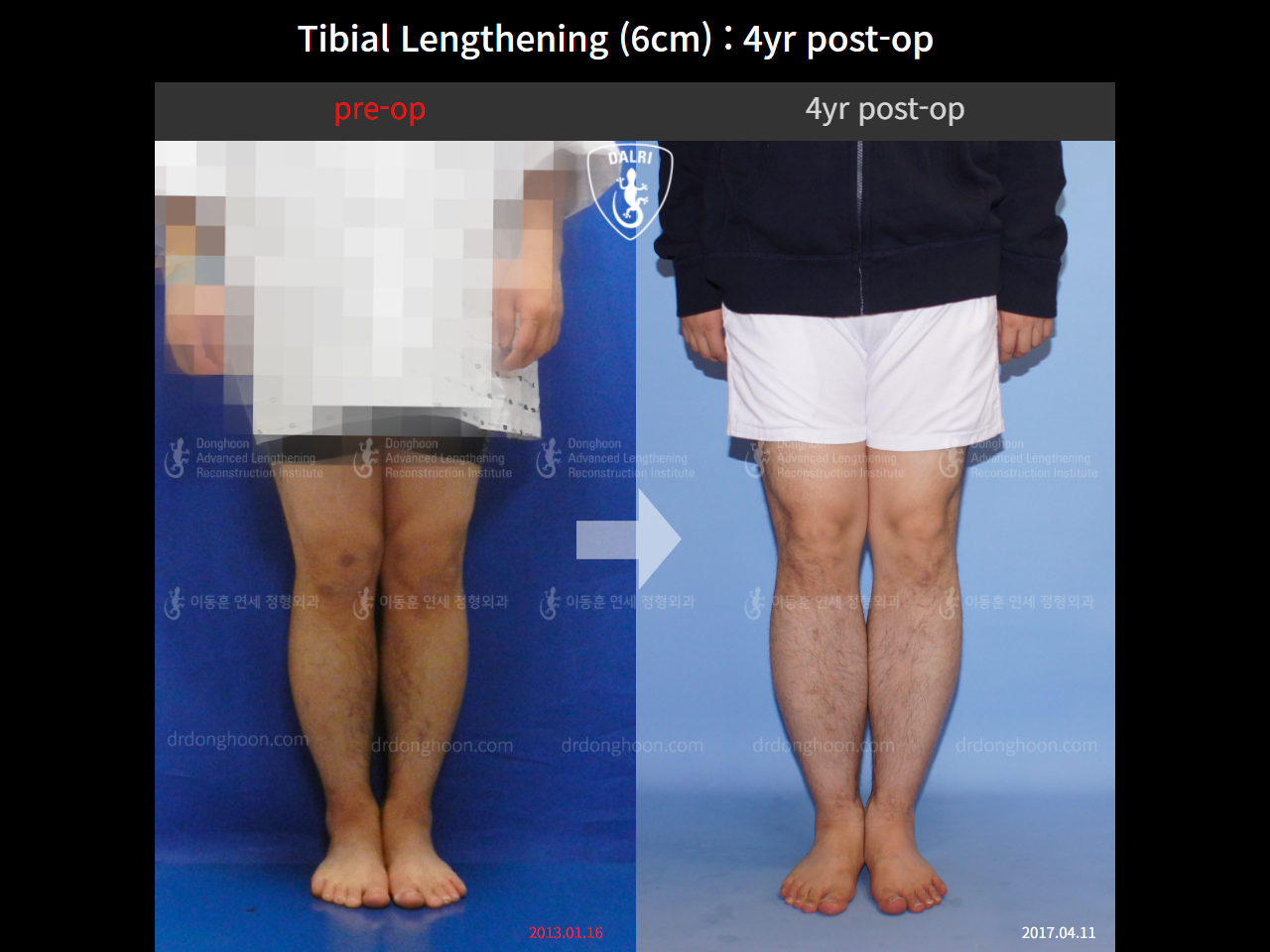 Before and after cll lon, case 10474212, image 4, Dr. Donghoon institute (DALRI)