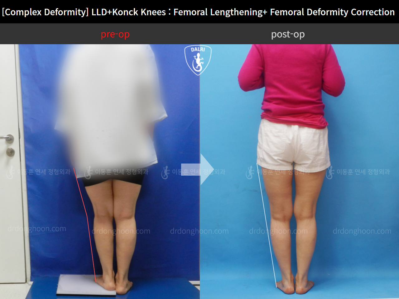 Before and after adult lld, case 11107365, image 2, Dr. Donghoon institute (DALRI)