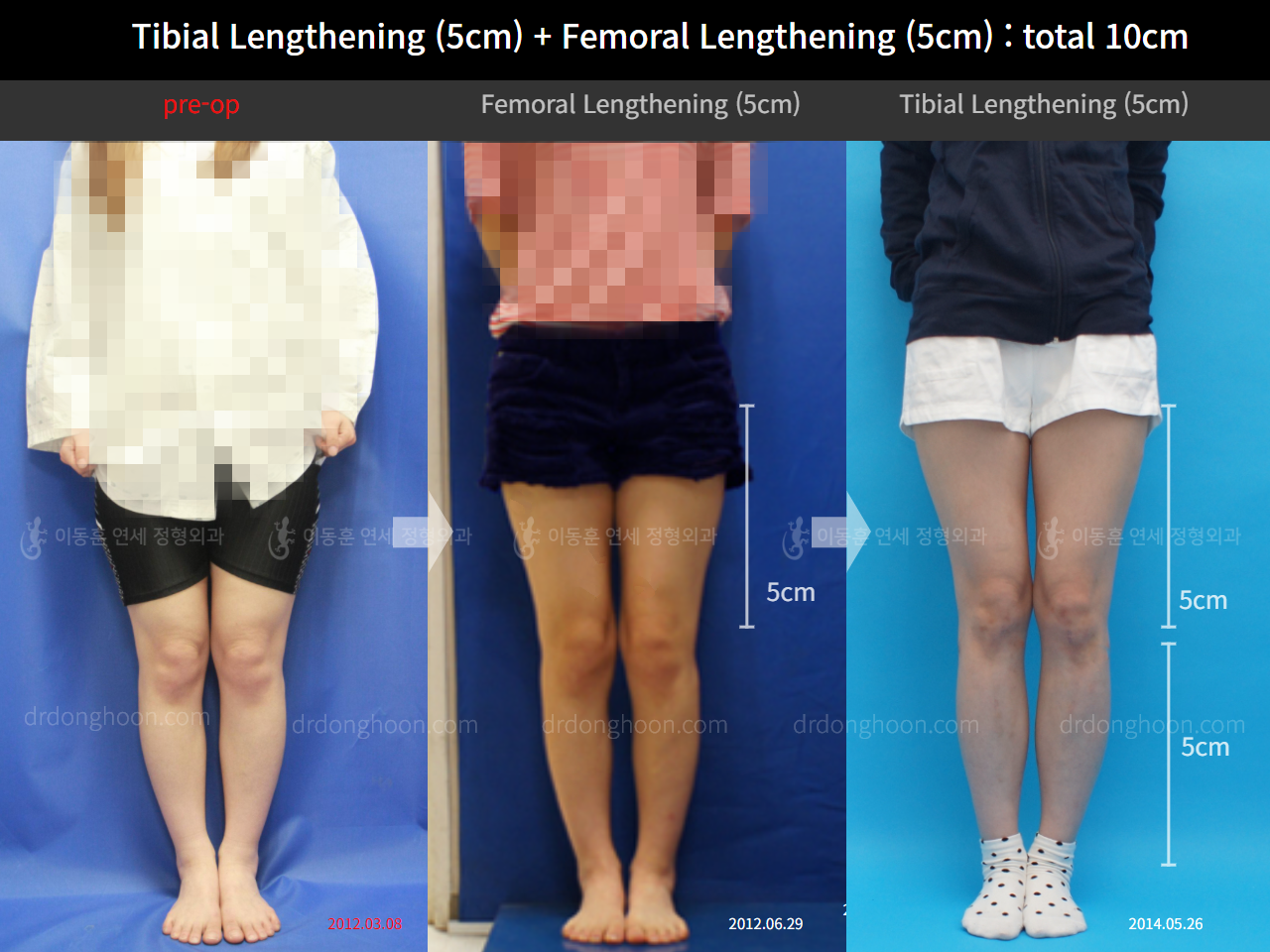Before and after cll lon, case 11035009, image 1, Dr. Donghoon institute (DALRI)
