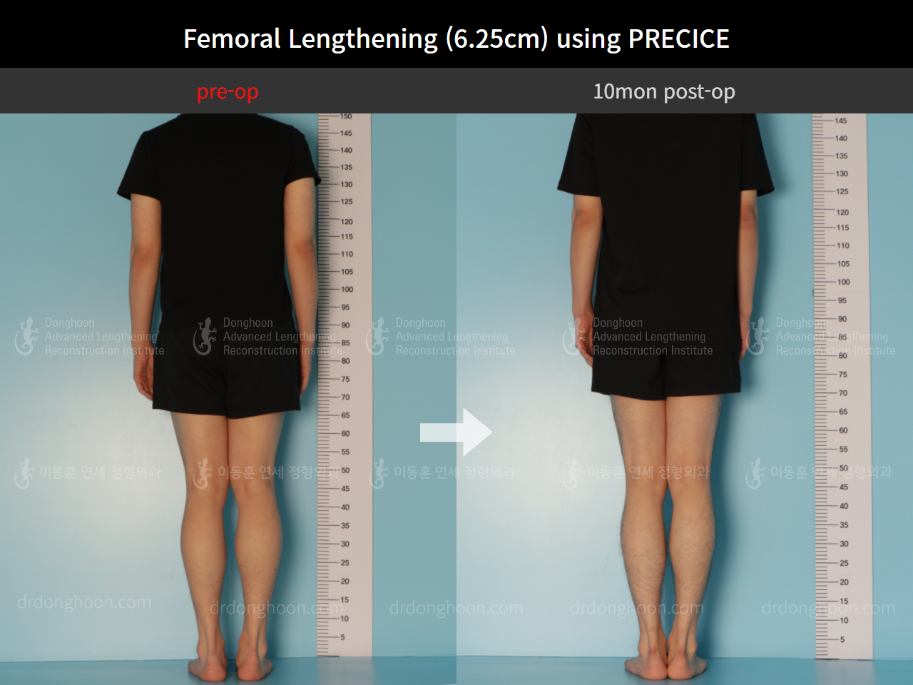 Before and after cll precice, case 8759307, image 2, Dr. Donghoon institute (DALRI)