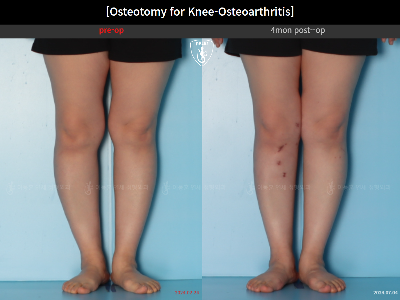 Before and after osteotomy for knee osteoarthritis, case 39778471, image 9, Dr. Donghoon institute (DALRI)