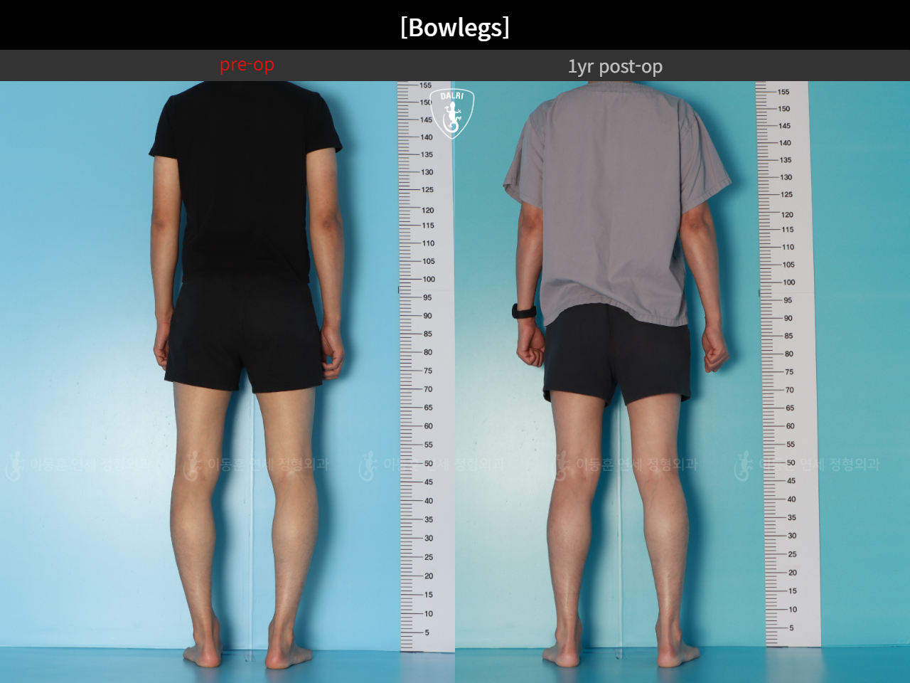 Before and after adult bowlegs, case 32564251, image 9, Dr. Donghoon institute (DALRI)
