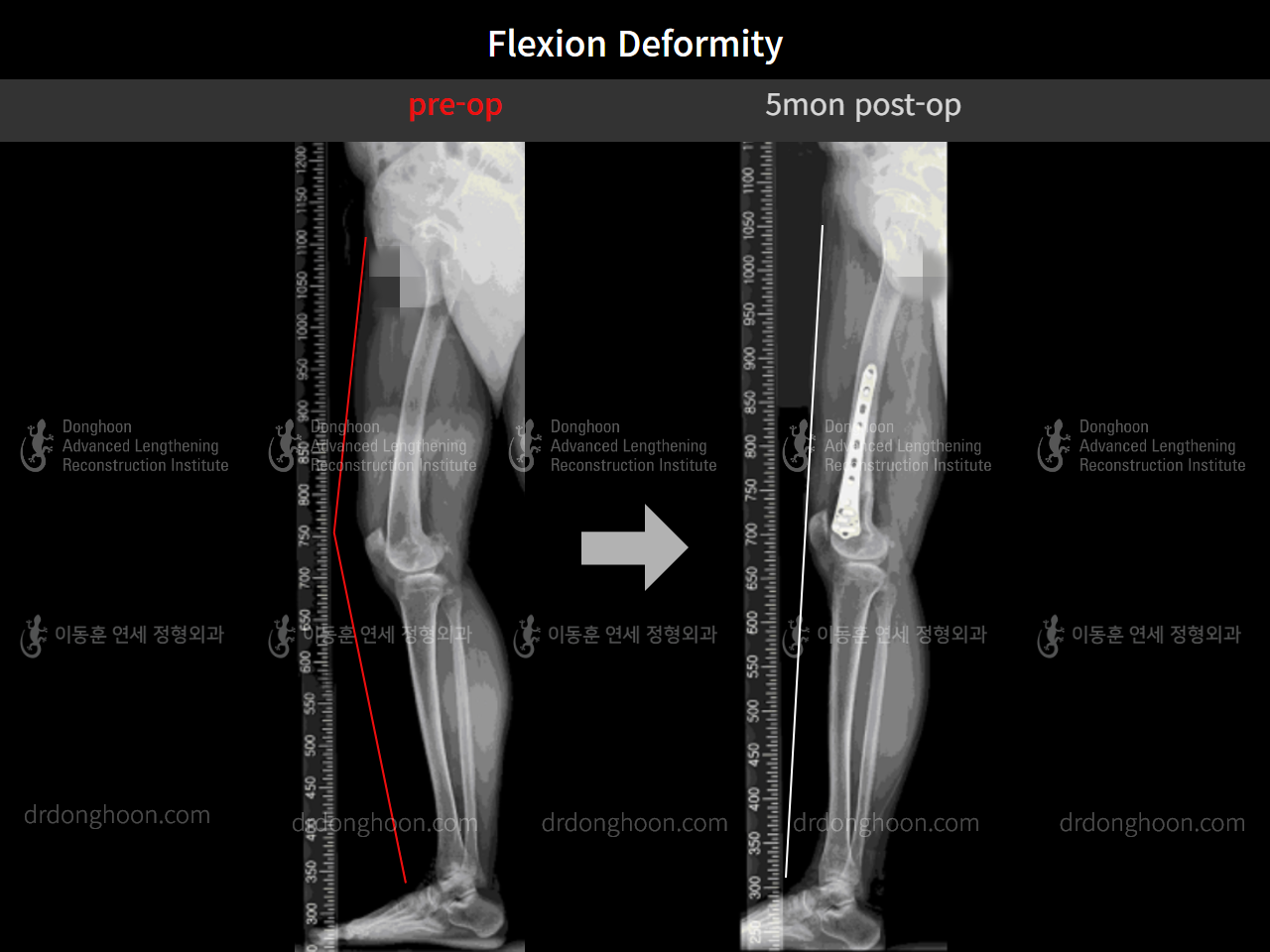 Before and after flexion deformity, case 9074441, image 3, Dr. Donghoon institute (DALRI)