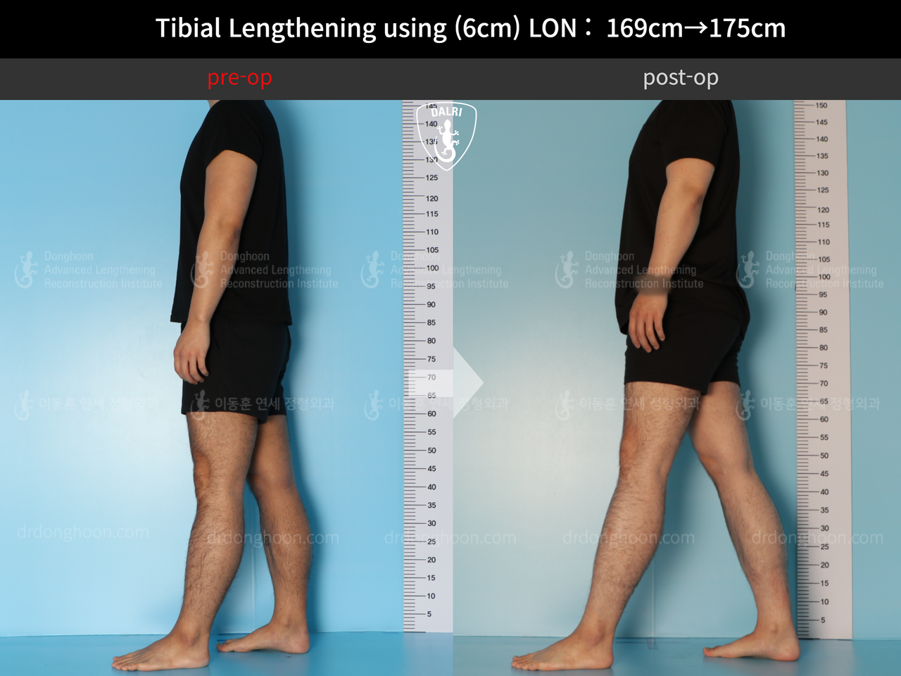 Before and after cll lon, case 12279515, image 4, Dr. Donghoon institute (DALRI)