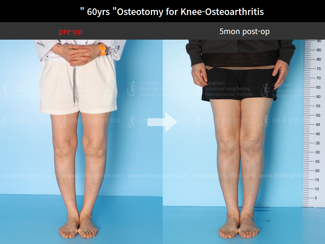 Before and after osteotomy for knee osteoarthritis, case 4586357, image 4, Dr. Donghoon institute (DALRI)