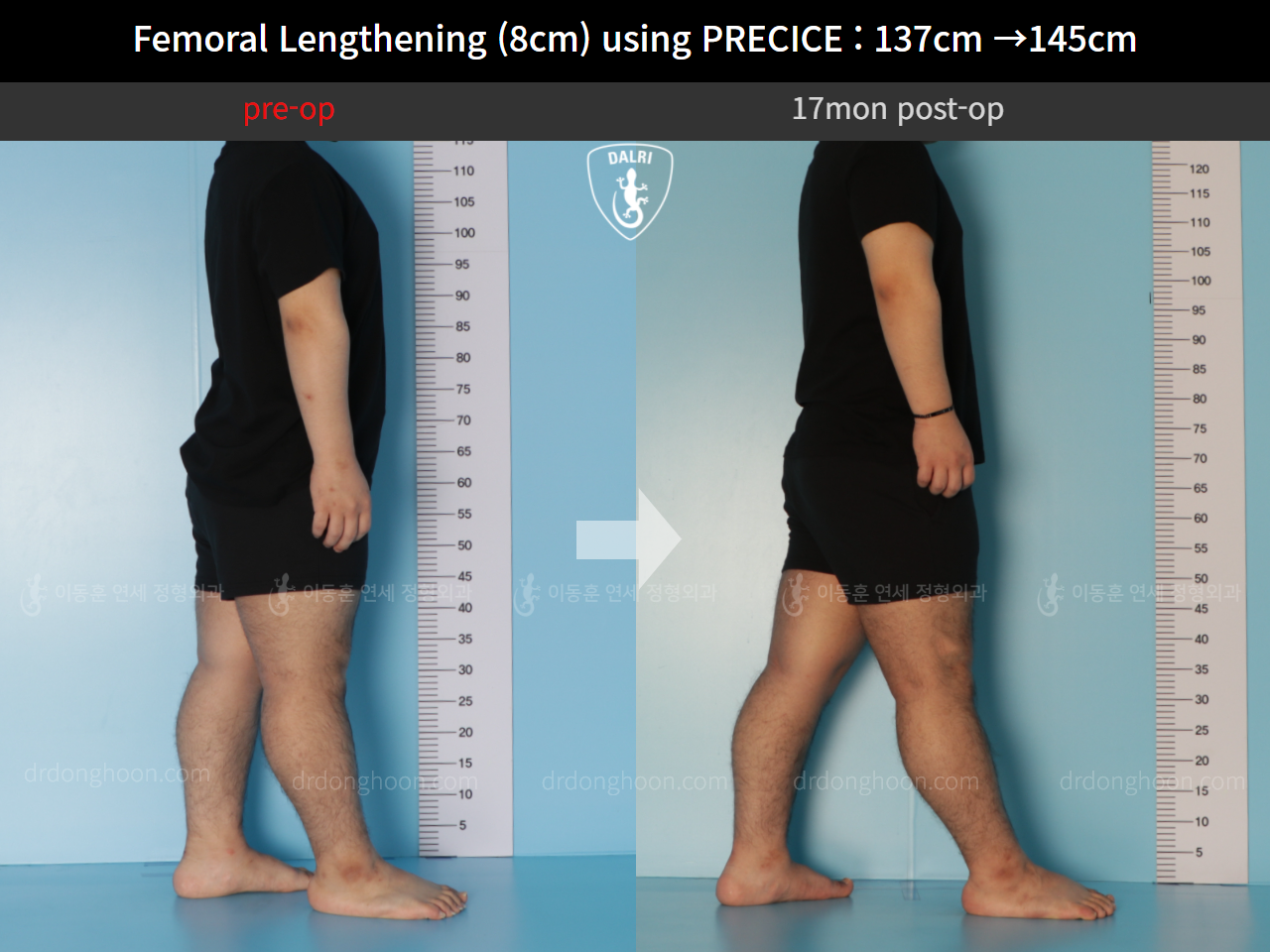 Before and after cll precice, case 9658893, image 3, Dr. Donghoon institute (DALRI)