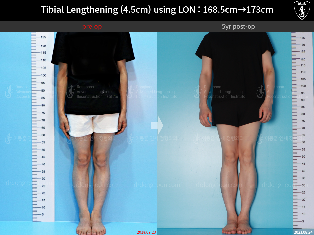 Before and after cll lon, case 16140967, image 3, Dr. Donghoon institute (DALRI)