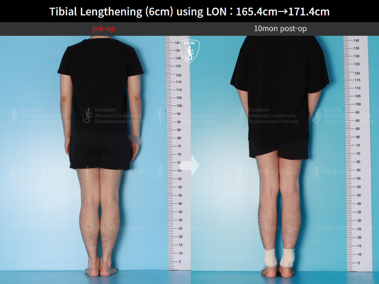Before and after cll lon, case 15716525, image 3, Dr. Donghoon institute (DALRI)