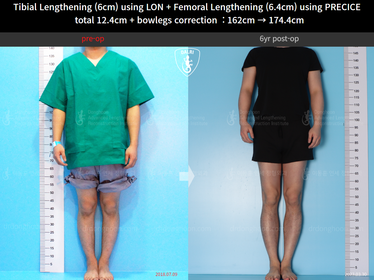 Before and after cll precice, case 14631295, image 5, Dr. Donghoon institute (DALRI)