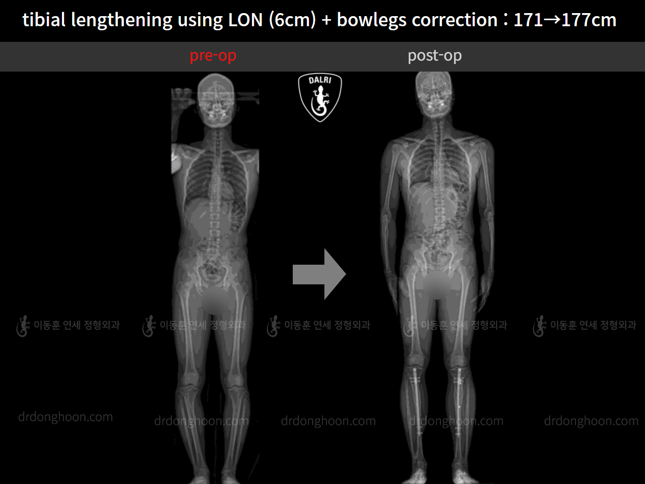 Before and after cll + deformity correction, case 11798378, image 6, Dr. Donghoon institute (DALRI)