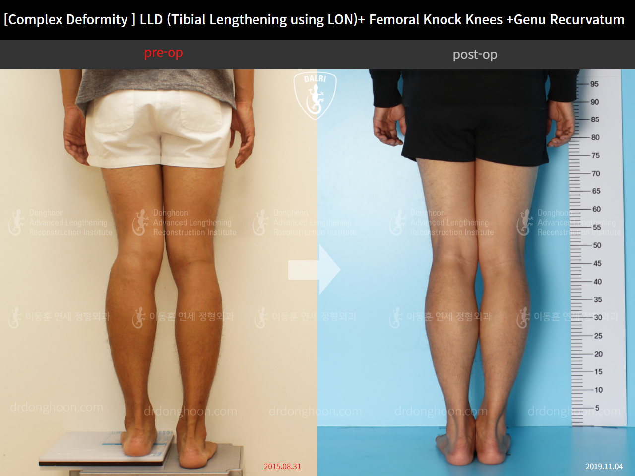 Before and after adult lld, case 4320339, image 5, Dr. Donghoon institute (DALRI)